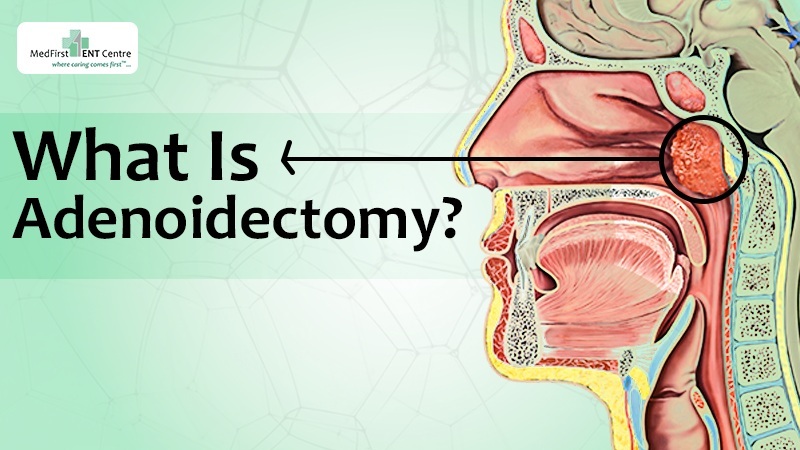 Adenoidectomy